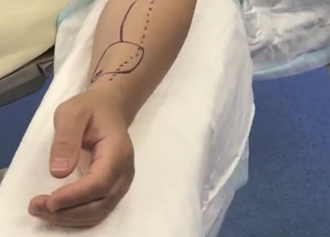 un avant-bras lors d'une chirurgie de lambeau