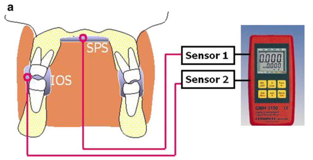Mesure des pressions intra-orales par W. Engelke